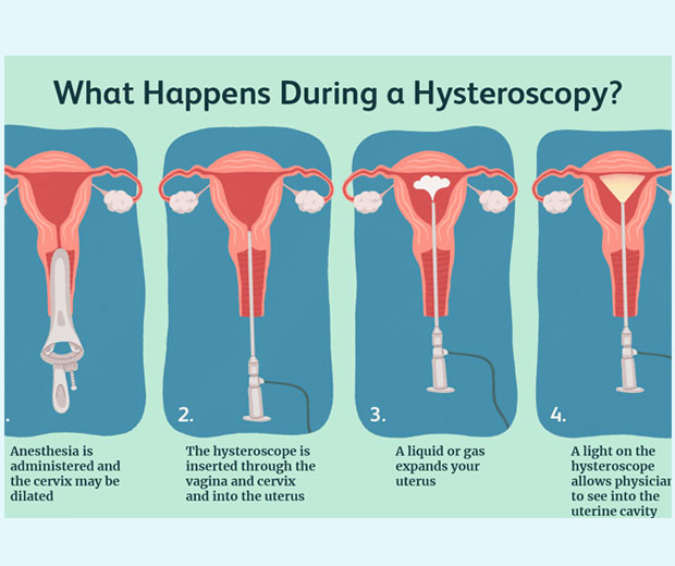 Sparsha Infertility Centre | Hysteroscopy