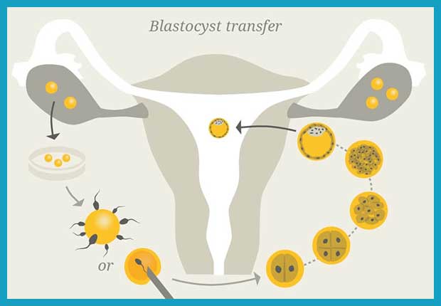Sparsha Infertility Centre | Blastocyst Culture and Transfer