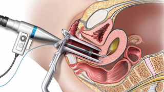 Hysteroscopy