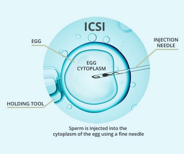Sparsha Infertility Centre | ICSI