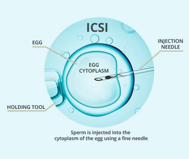 icsi とは