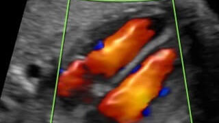 Fetal Echocardiography